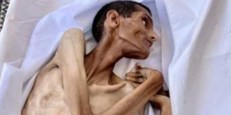 شاب فلسطينى يموت جوعا فى مستشفى الشفاء الطبى بغزة.. صورة