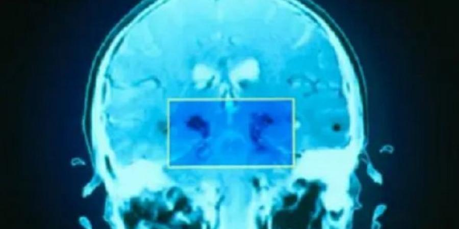 6 حيل تعالج الضغط العصبي والقلق ومشاكل المخ