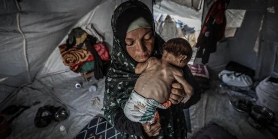 الأمم المتحدة: سوء التغذية الحاد بين الأطفال بغزة وصل أعلى مستوى