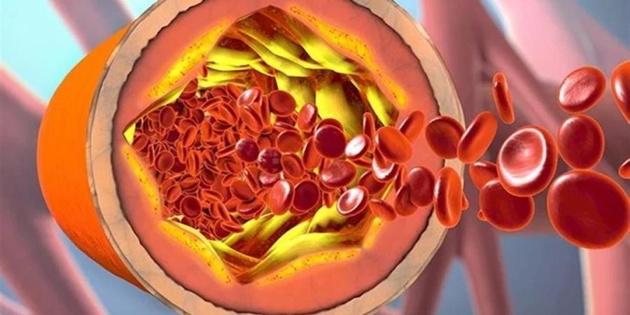المكملات الغذائية الفعالة في خفض مستويات الكوليسترول المرتفع