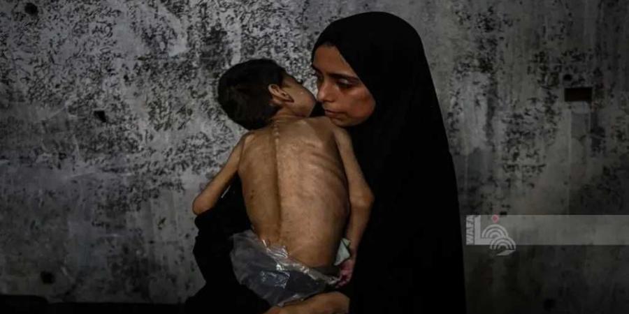 5 وفيات بينهم طفل نتيجة المجاعة وسوء التغذية خلال الساعات الـ24 الماضية