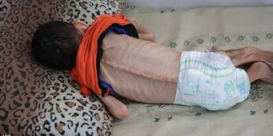 الأمم المتحدة: وفاة أكثر من 100 طفل في غزة بسبب سوء التغذية